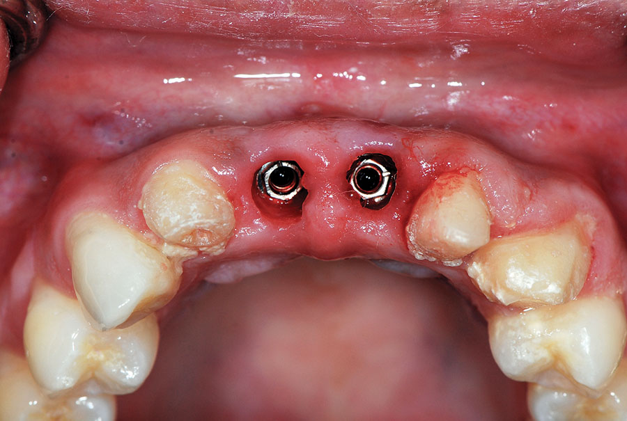 Implant without surgery  ایمپلنت بدون جراحی Kurtzman figure 10