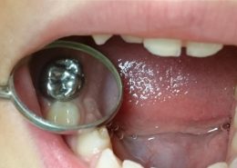 اس اس کرون [object object] مراقبت های پس از درمان ریشه Stainless steel crowns 260x185  مطالب دندانپزشکی Stainless steel crowns 260x185