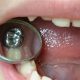 اس اس کرون  پالپوتومی دندان چیست؟ Stainless steel crowns 80x80