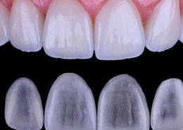 What are Lumineers? [object object] مراقبت های پس از درمان ریشه carillas dentales ultrafinas 260x185  مطالب دندانپزشکی carillas dentales ultrafinas 260x185