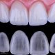 What are Lumineers?  انواع آسیب های دندان کودکان carillas dentales ultrafinas 80x80