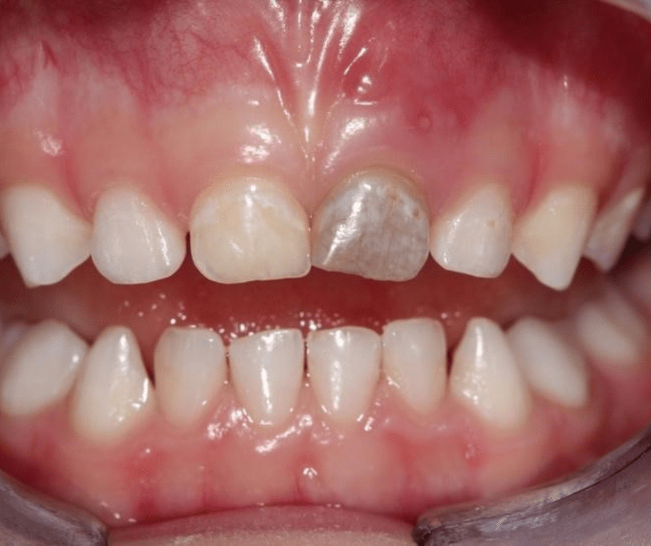 انواع آسیب های دندان کودکان dentaltrauma tooth discolouration