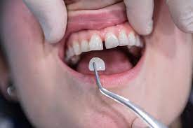 Installation steps of dental luminaries  لومینیرز چیست؟ images 8