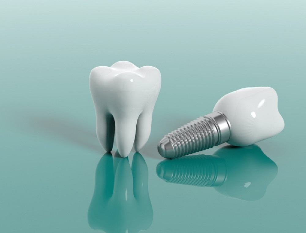 ایمپلنت در شیراز   4 advantages of dental implants