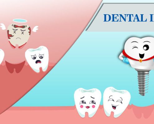 Advantages of dental implants  بریج بهتر است یا ایمپلنت Benefits of Dental Implants 495x400