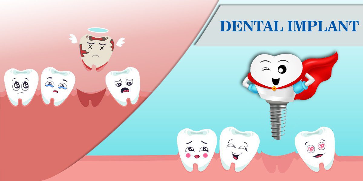Advantages of dental implants  ایمپلنت چگونه زندگی شما را تغییر میدهد؟ Benefits of Dental Implants