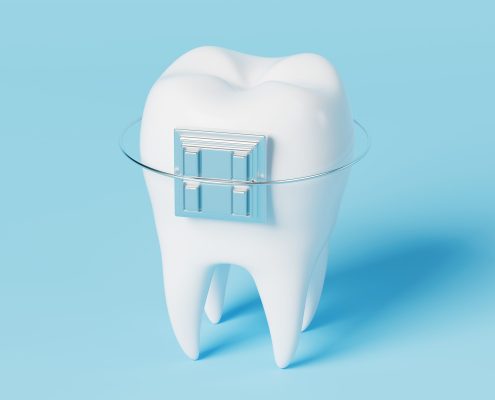 انواع برندهای ایمپلنت Single tooth 495x400