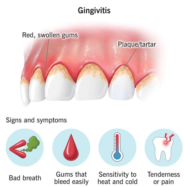 Gingival analysis/دندانپزشکی در شیراز  عواملی که شما را در معرض خطر تحلیل لثه قرار می دهد gingivit