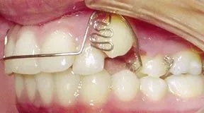 ارتودنسی تک دندان ortho 06 before