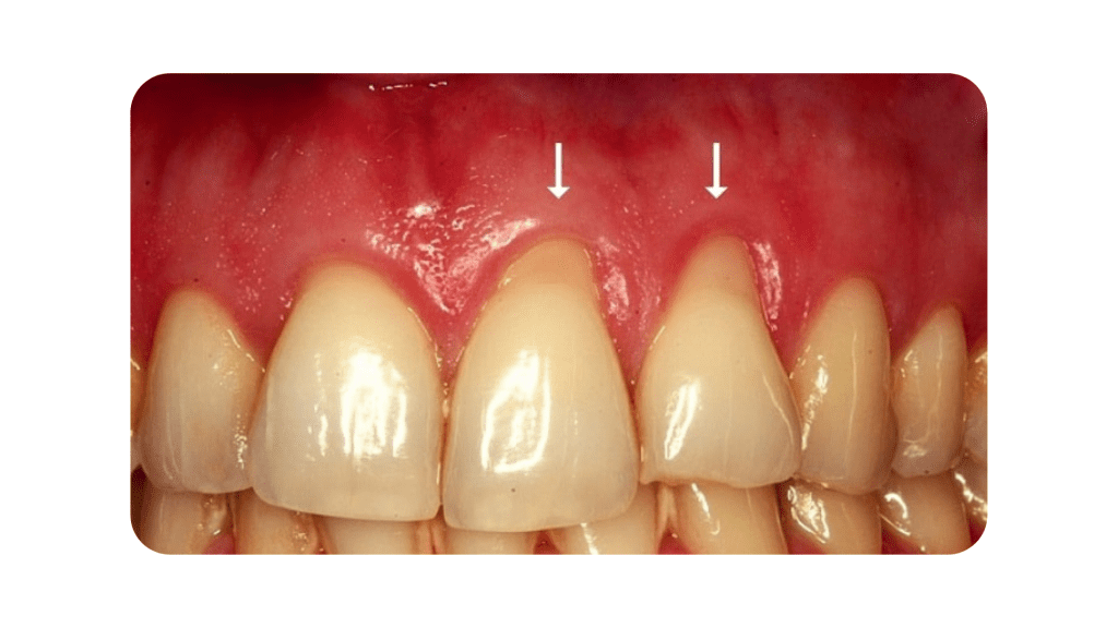 Reasons for receding gums  عواملی که شما را در معرض خطر تحلیل لثه قرار می دهد receding