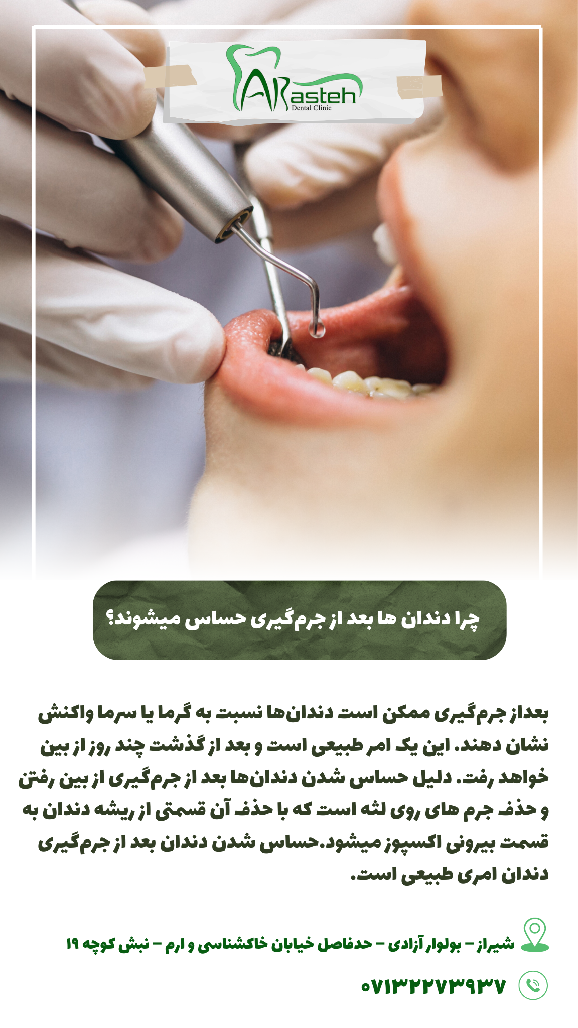 حساس شدن دندان بعد از جرمگیری                                                     20240526 155940 0000