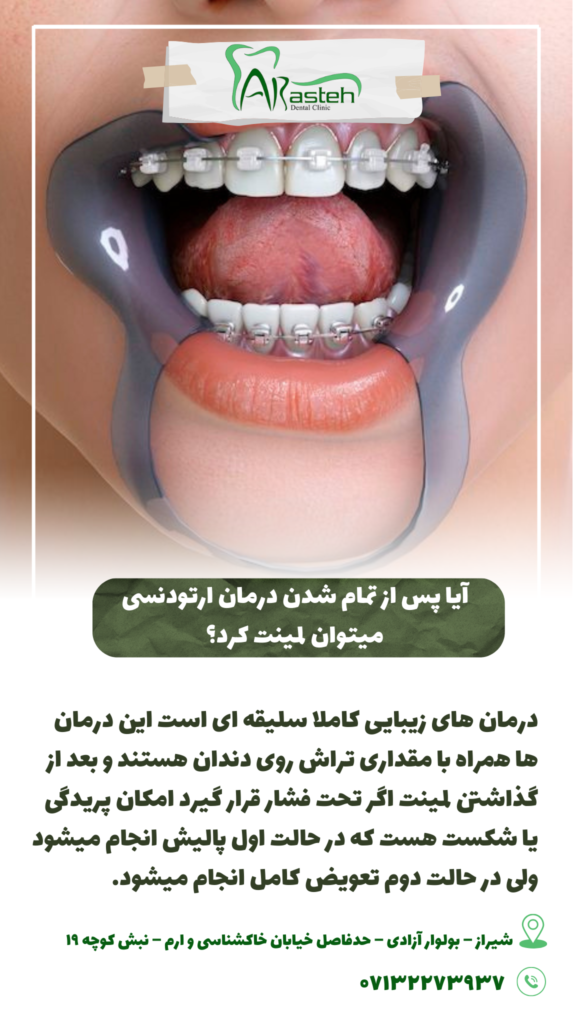 پیش‌نویس خودکار ارتودنسی و لمینت                                                     20240608 095148 0000