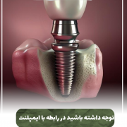 ایمپلنت پیش‌نویس خودکار پری کرونیت چیست؟                                           20240526 085934 0000 e1719733886698 180x180