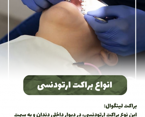 پیش‌نویس خودکار پری کرونیت چیست؟                                                     20240625 125039 0000 495x400