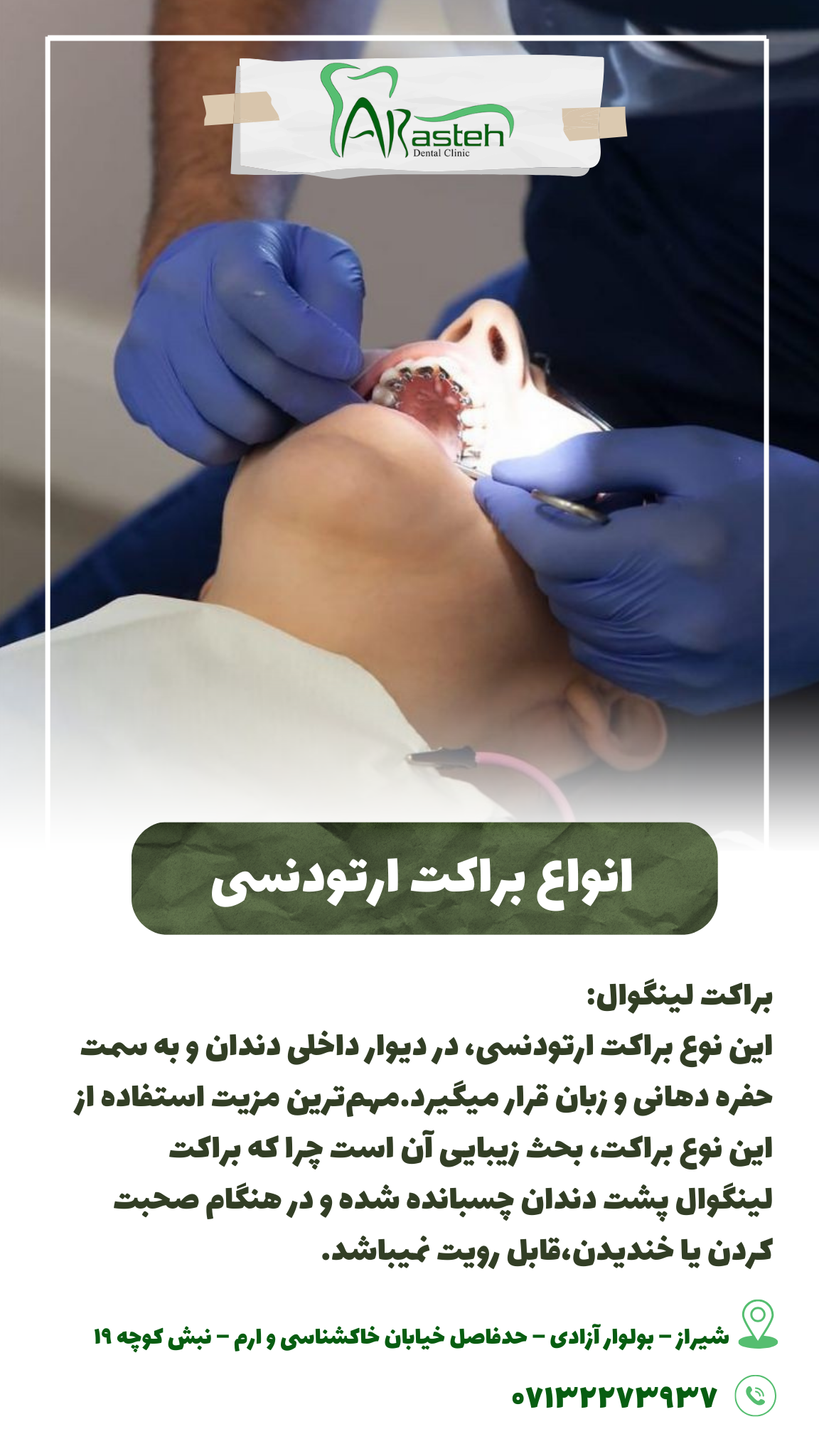 پیش‌نویس خودکار انواع براکت ارتودنسی                                                     20240625 125039 0000