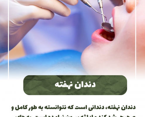پیش‌نویس خودکار انواع دندان عقل نهفته                                                     20240712 111326 0000 495x400