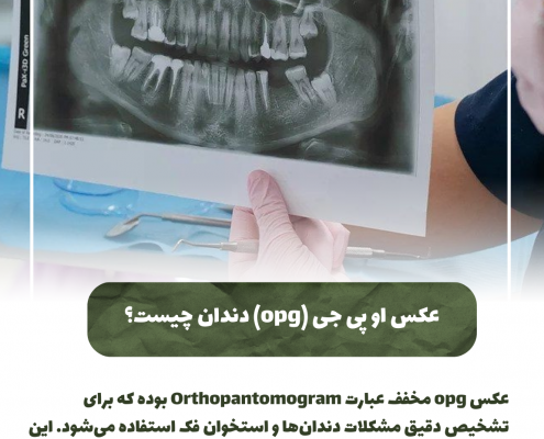 پیش‌نویس خودکار انواع دندان عقل نهفته                                                     20240714 192722 0000 495x400