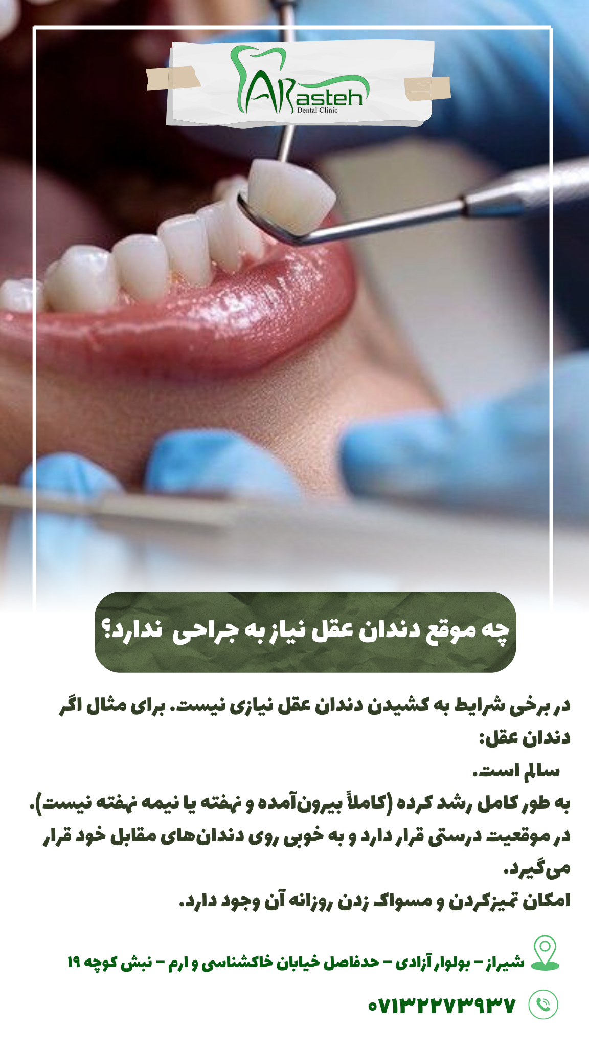 پیش‌نویس خودکار دندان عقل چه موقع نیاز به جراحی ندارد؟                                                     20240829 132239 0000