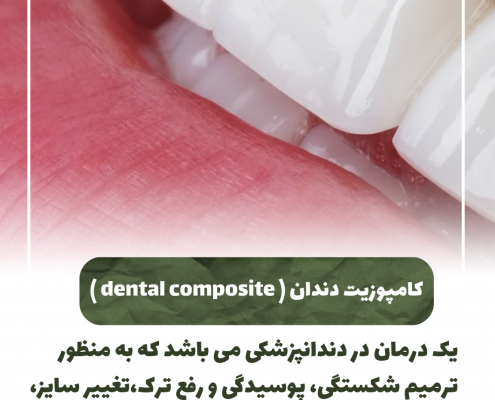 پیش‌نویس خودکار کامپوزیت دندان 1 20240723 155251 0000 495x400