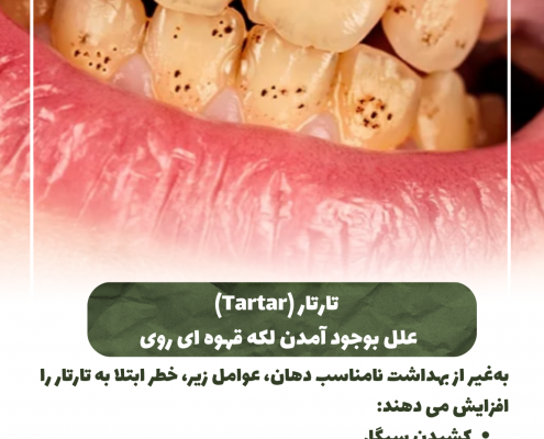 پیش‌نویس خودکار کامپوزیت دندان IMG 20250319 133326 144 495x400