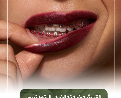 پیش‌نویس خودکار ارتودنسی با پلاک شفاف IMG 20250319 133326 309 e1765735621504 495x400