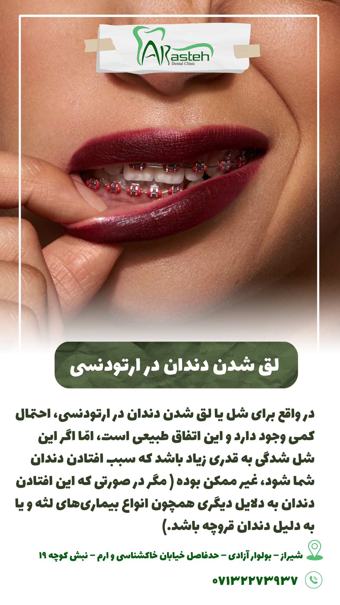پیش‌نویس خودکار لق شدن دندان در ارتودنسی IMG 20250319 133326 309